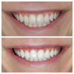 blanchiment des dents Tunisie