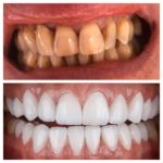 hollywood smile prix