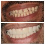 facette dentaire avant apres