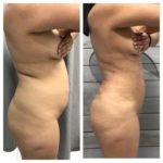 liposuccion prix tunisie