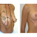 réduction mammaire tunisie avant après