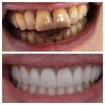 facette dentaire prix tunisie