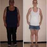 bypass gastrique avant apres photo