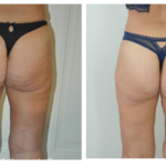 bodylift avant après