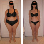 ballon gastrique tunisie avant après