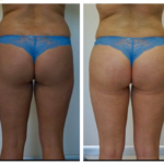 lipofilling fesses tunisie avant après