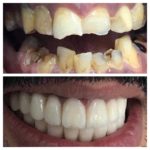 facette avant après