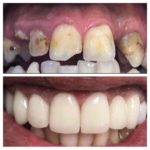 facette lumineers tunisie avant après