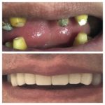 implants dentaire tunisie avant après