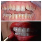 facette dentaire prix tunisie avant après