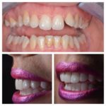 facette dentaire avant après