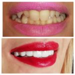 facette prix tunisie avant après