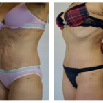 abdominoplastie en tunisie avant après tarifs