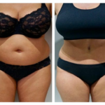 abdominoplastie en tunisie prix
