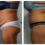 abdominoplastie en tunisie prix avant après