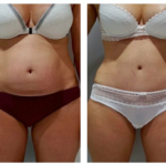 abdo liposuccion en tunisie