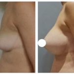 augmentation mammaire en tunisie avant après