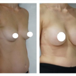 augmentation seins tunisie avant après