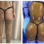 augmentation des fesses en tunisie tarifs