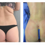 augmentation des fessiers en tunisie