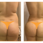 augmentation fesses en tunisie tarifs