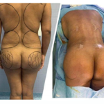 augmentation des fessiers en tunisie tarif