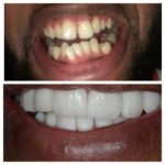 facette dentaire en Tunisie avant après