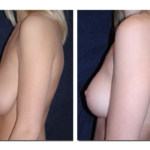 augmentation mammaire avant après