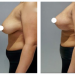 augmentation mammaire prix tunisie avant après