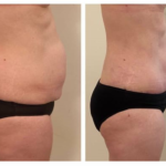 plastie abdominal avant après tunisie