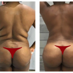 lipofilling fesses en tunisie prix