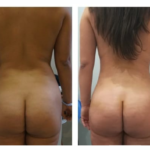 lipofilling fessiers avant après tunisie
