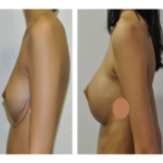 augmentation mammaire pas cher avant aprés