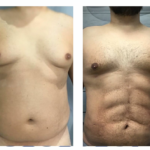 abdominoplastie avant après