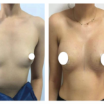 augmentation mammaire tarif tunisie avant après