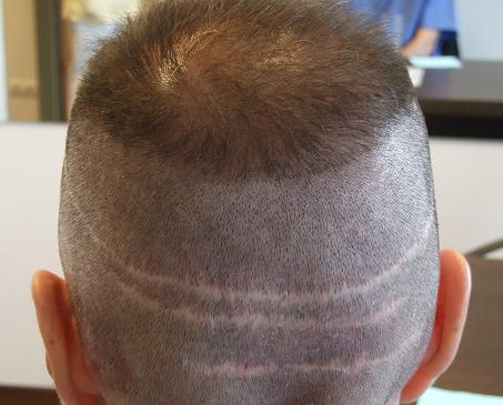 greffe de cheveux fue