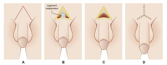 chirurgie penoplastie
