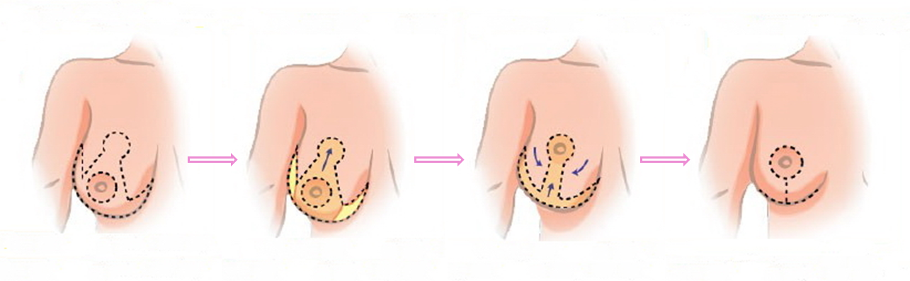Réduction_mammaire_étapes