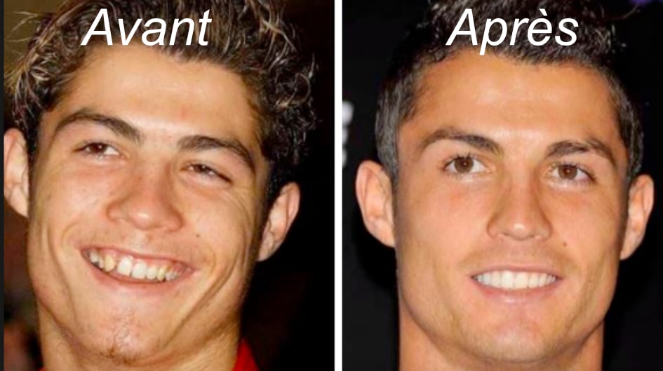 cristiano ronaldo avant chirurgie esthétique